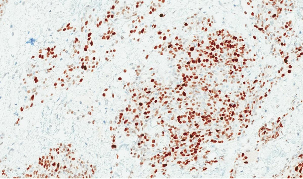 DrCycloPath's tweet image. #PathQuiz 🔬#BreastPath

Infiltrative neoplasm composed of single cells and cords forming slit-like spaces
MYC overexpressed

A) Primary angiosarcoma
B) Atypical vascular lesion
C) Post ☢️ angiosarcoma
D) Metaplastic carcinoma

#Pathology  @IARCWHO