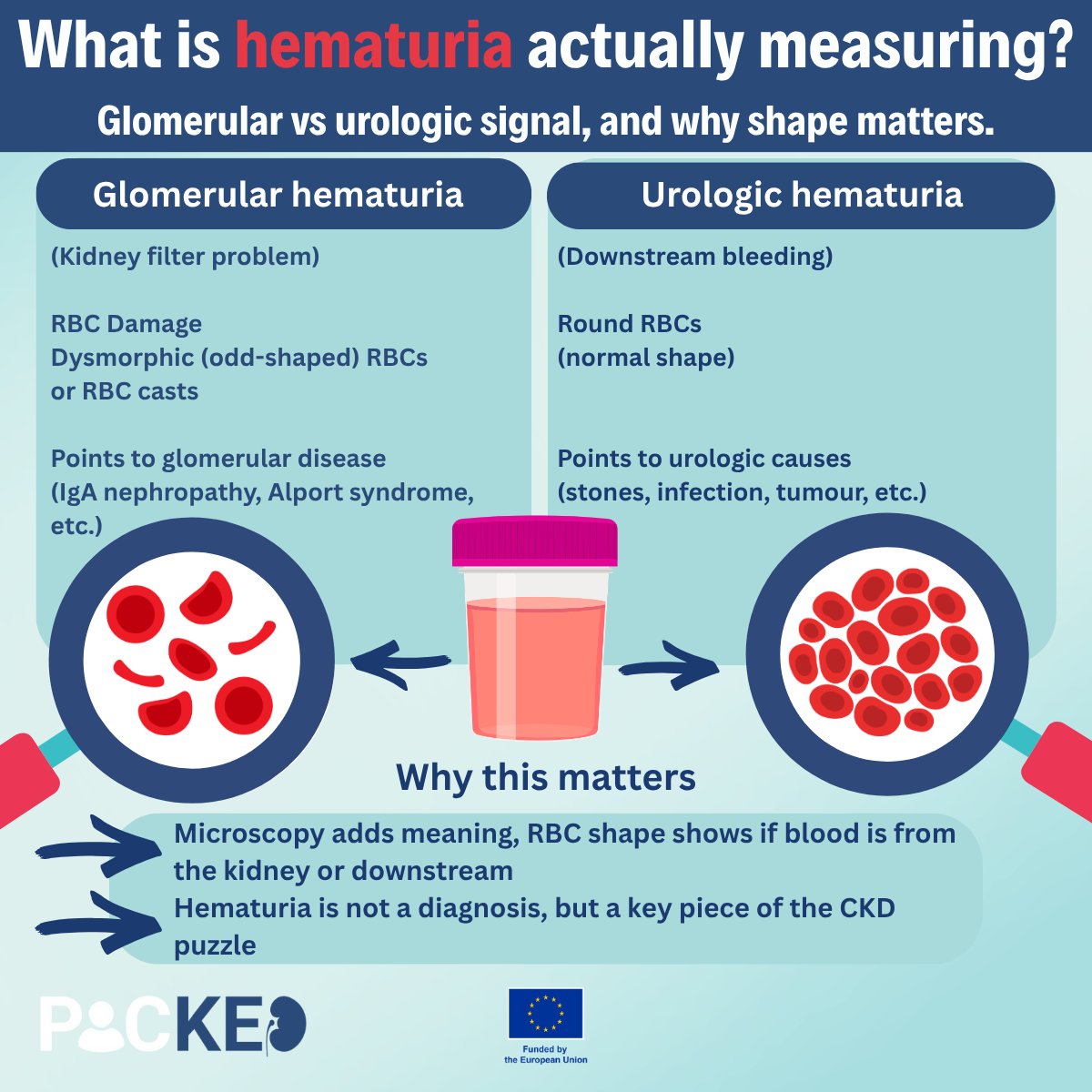 PROJECTPICKED's tweet photo. Hematuria = blood in urine, but where it comes from matters.

Glomerular (kidney filter) → dysmorphic red blood cells (RBCs) / RBC casts.
Urologic (downstream) → round, normal RBCs.
Microscopy adds meaning.

#CKD #Hematuria #KidneyHealth #PICKEDproject https://t.co/FIpDOiu0CP