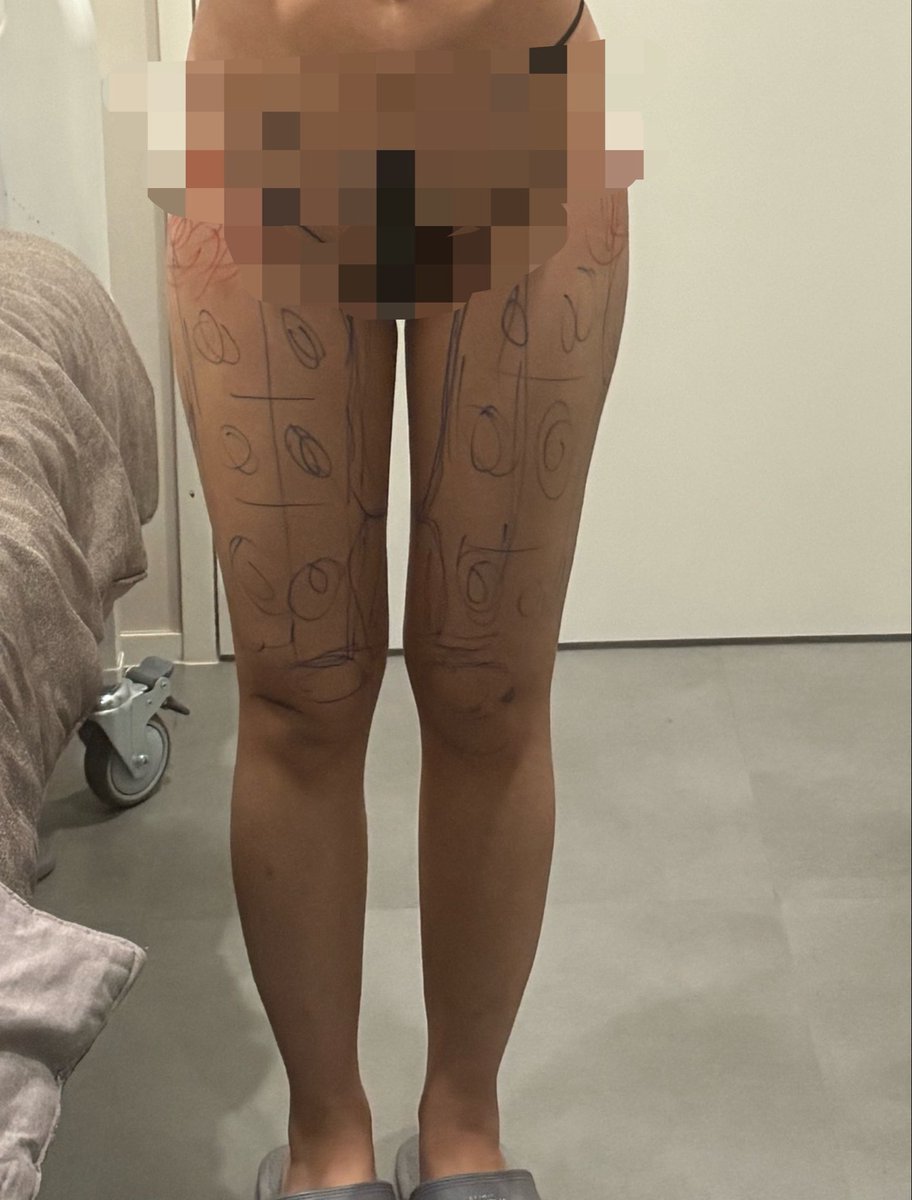 いがいがうに　太もも脂肪吸引dt tweet media