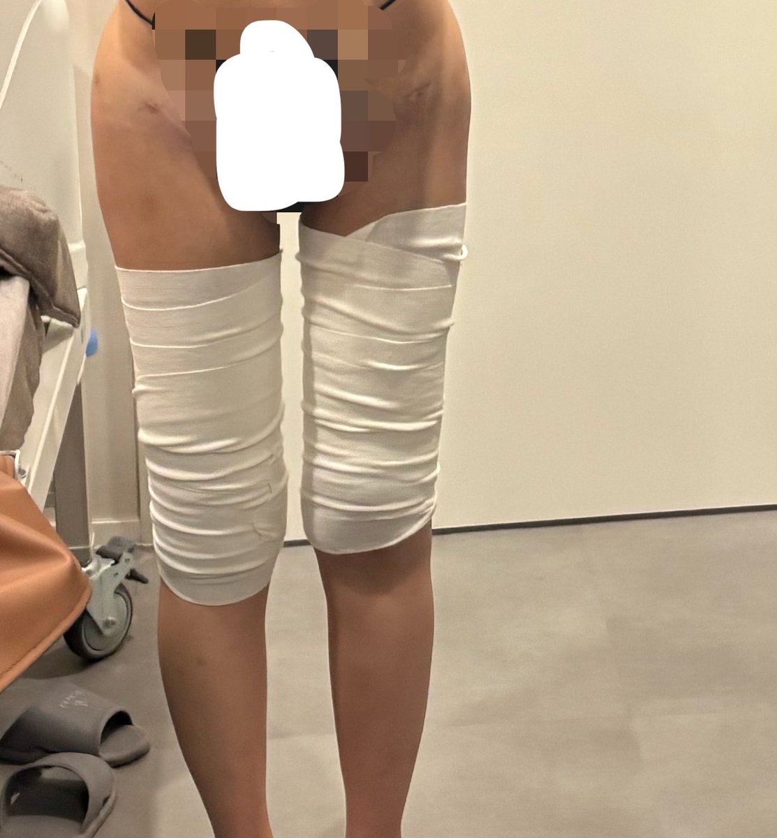 いがいがうに　太もも脂肪吸引dt tweet media