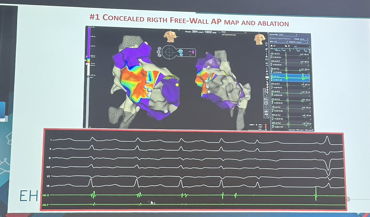 Dr_Ahmed_Ammar's tweet image. Back to Basic Electrophysiology 

Nice educational case and discussion of AVRT by @AndreaSarkozy at #EHRA26 

#EPeeps
