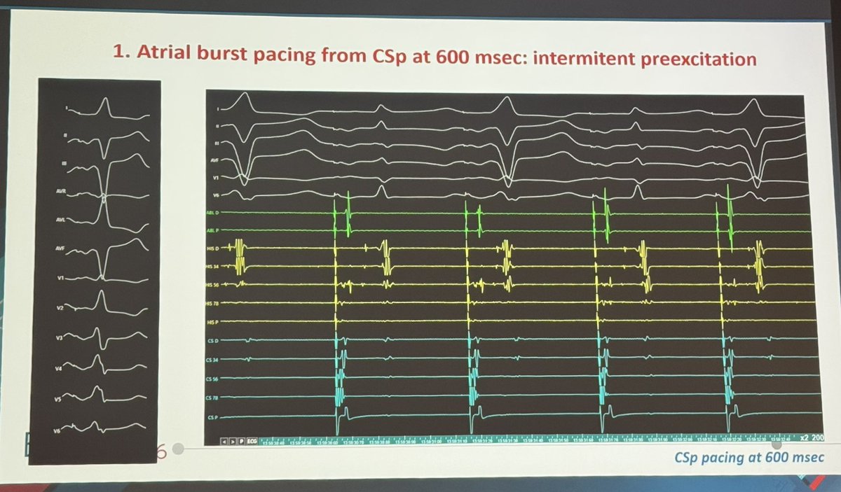 Dr_Ahmed_Ammar's tweet image. Back to Basic Electrophysiology 

Nice educational case and discussion of AVRT by @AndreaSarkozy at #EHRA26 

#EPeeps
