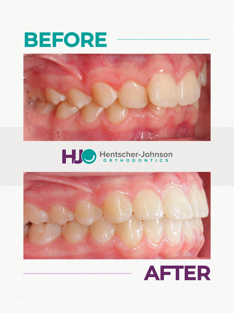 HJOrthodontics's tweet image. What a picture-perfect HJO smile! ✨ After 24 months in braces, this patient is showing off a full, confident smile. 😁

Ready to start your smile journey? ⬇️

📞 | (618) 400-0900
🖥 | vist.ly/4yfmg

#TransformationTuesday #HJOrtho #NewSmile #Braces