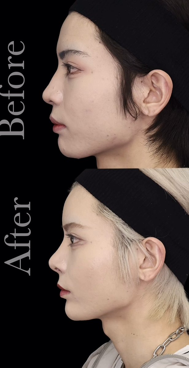 みょん◡̈【輪郭3点+目頭目尻タレ目DT中🏥】整形匿名タレコミ質問募集中 tweet media