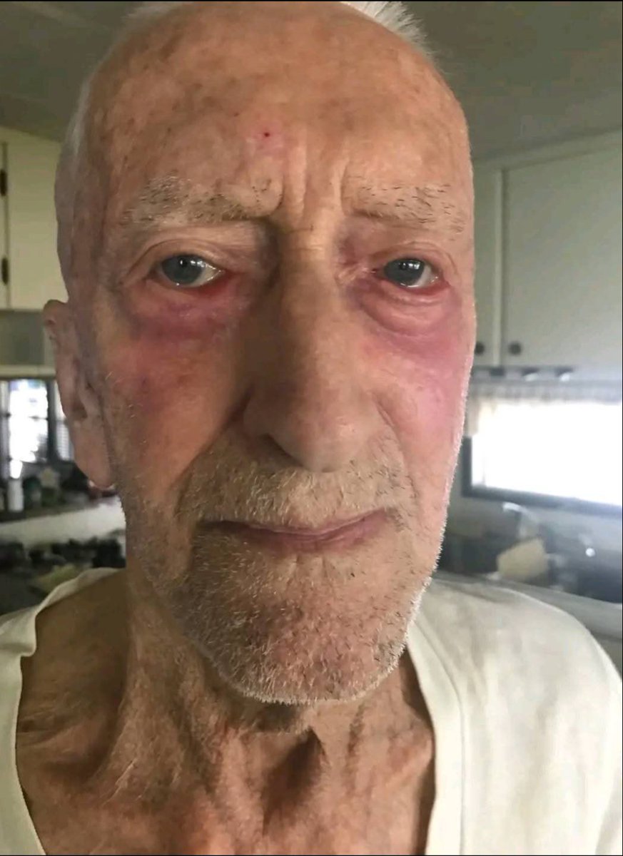 IVERMECTIN Topical Cream Testimonial - 88 year old Alberta farmer with  skin Cancer has 4 tubes of Ivermectin paste sent to him by his son

More and more Topical Ivermectin testimonials are starting to come in...

88 year old farmer in Alberta was diagnosed with skin cancer 

His