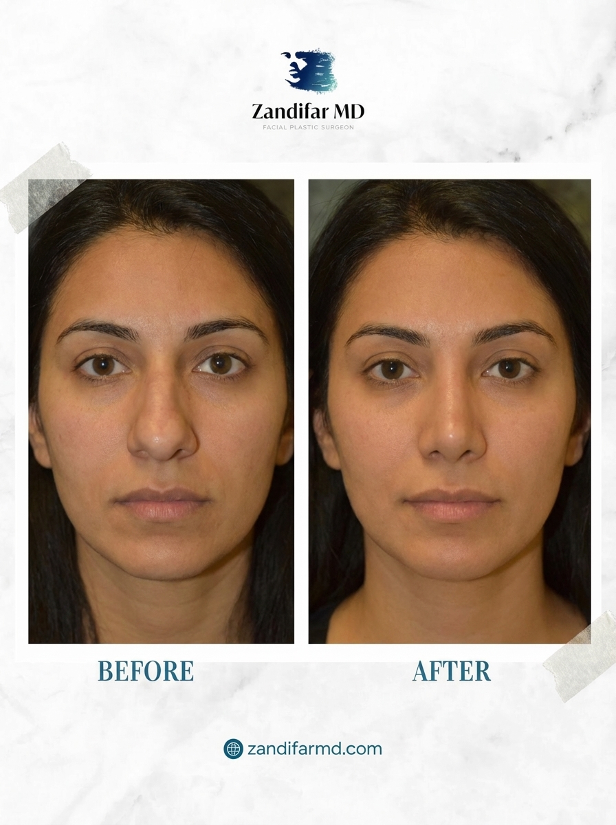 ZandifarMD's tweet image. Rhinoplasty isn’t about changing your face — it’s about refining it.
Natural, balanced, and personalized results.
.
#ZandifarMD #Rhinoplasty #BeforeAfter #FacialAesthetics #NaturalResults