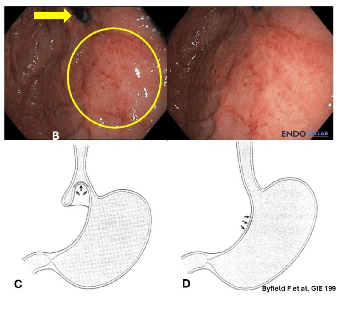 theendoscopist's tweet photo. Hematemesis after vomiting. Not always Mallory-Weiss.

35-year-old man. Nausea, vomiting, then hematemesis.

EGD: prolapsed gastric fundus mucosa with erythema, edema, and congestion. Lesser curvature prolapsed into the esophagus from retching.

Prolapse gastropathy — also called mechanical gastritis of the cardia.

First described in the late 1970s. Underrecognized cause of hematemesis.

The authors believe it's a precursor on the same barotrauma spectrum as Mallory-Weiss tears and Boerhaave's syndrome — the mildest end.

Treatment: address the underlying cause of nausea and vomiting.

By @theendoscopist | Garikipati & Mönkemüller