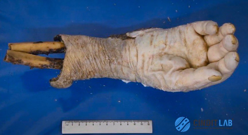 md_castaneda23's tweet photo. Carcinoma epidermoide de miembro superior derecho.
Producto de amputación
#cinditlab https://t.co/FJqIaOKJqL