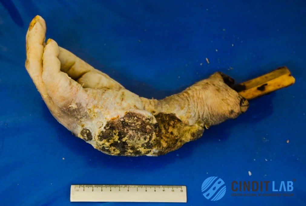 md_castaneda23's tweet photo. Carcinoma epidermoide de miembro superior derecho.
Producto de amputación
#cinditlab https://t.co/FJqIaOKJqL