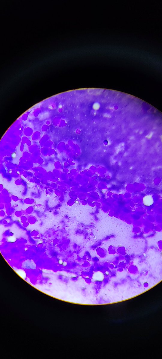 MunchManju95's tweet image. FNA lymph node 
What are findings observed here??
Your diagnosis?
#pathresidents 
#cytology 
#learnpathwithmanju
 
@ManjulaNavamani