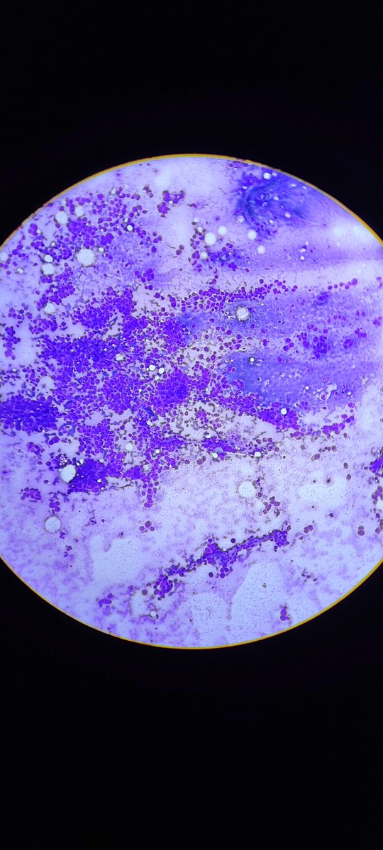 MunchManju95's tweet image. FNA lymph node 
What are findings observed here??
Your diagnosis?
#pathresidents 
#cytology 
#learnpathwithmanju
 
@ManjulaNavamani