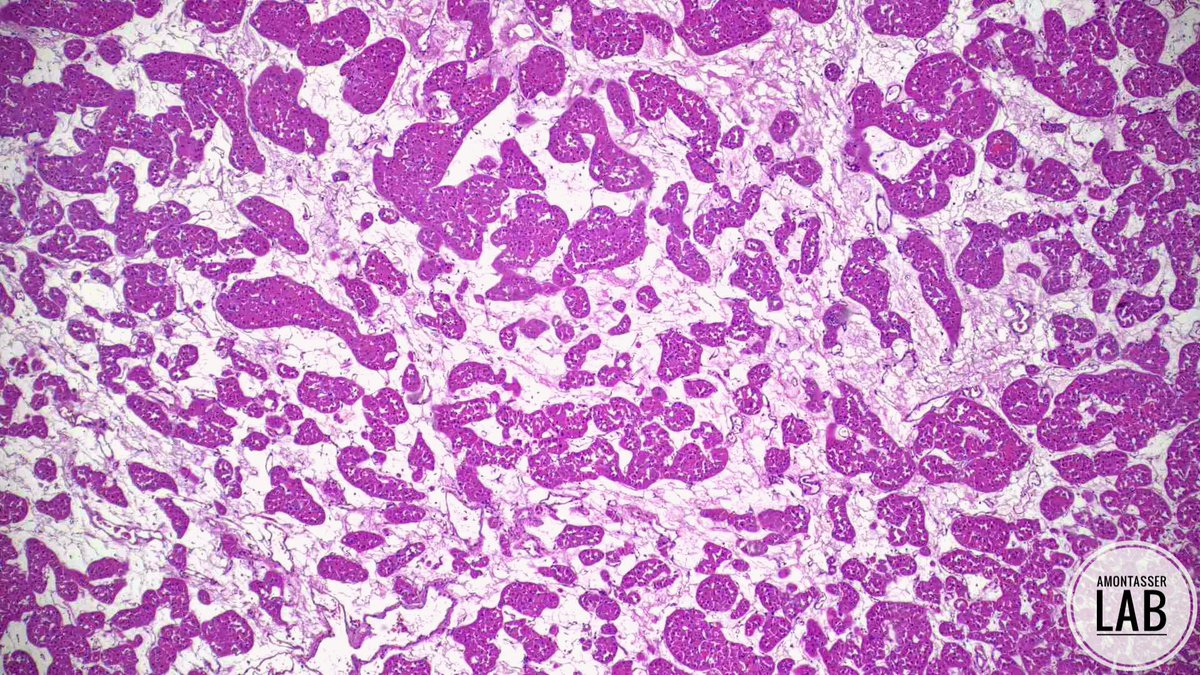 AMontasserMD's tweet image. Renal oncocytoma : Archipelago pattern 

#GUpath #Pathology #PathTwitter #PathX