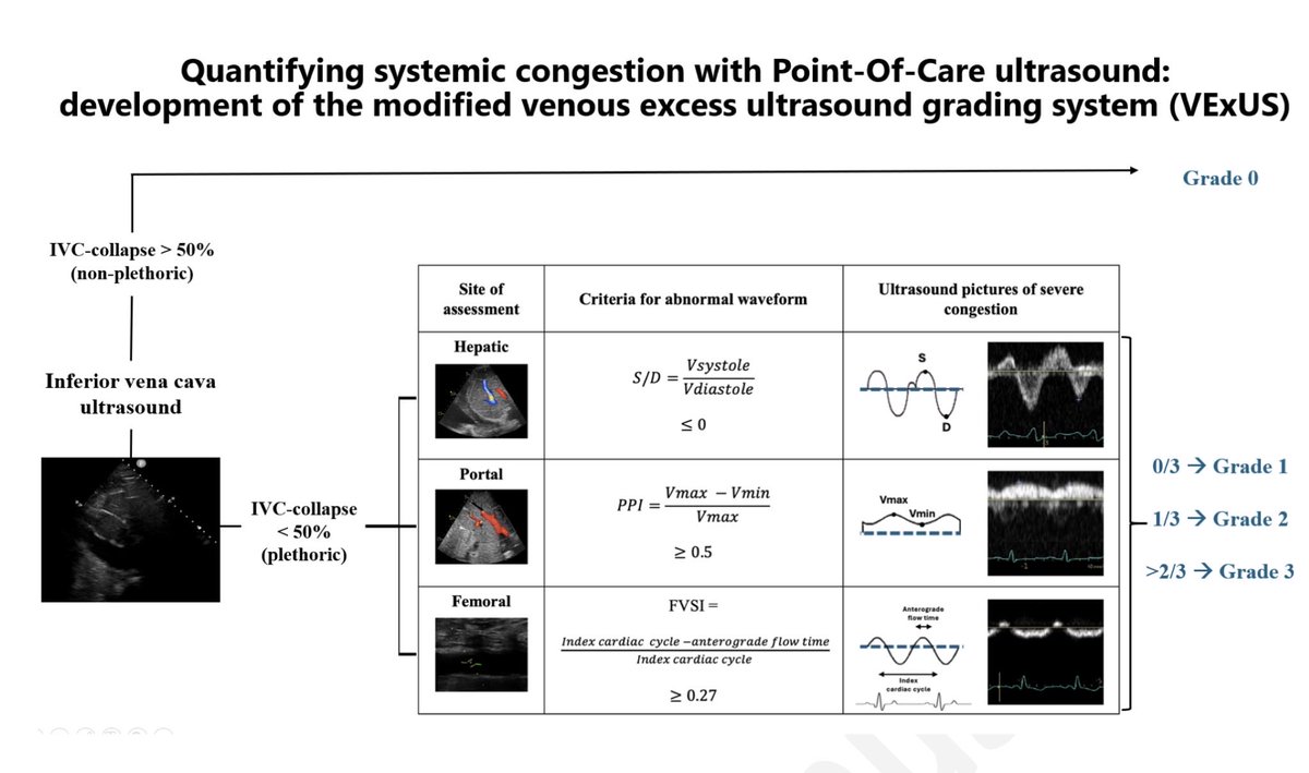 NephroP's tweet photo. Very interesting #VExUS study from our Canadian friends adding femoral vein Doppler into a modified VExUS approach.
What’s intriguing is that intradialytic hypotension showed up more often at both ends of the spectrum (grade 0 and grade 3), with grade 3 patients also having a much longer cumulative duration of hypotension.
Any comments/thoughts/deep dive into pathophysiology? @khaycock2 @ArgaizR @icmteaching 
🔗 https://t.co/vYQUaaqLfr