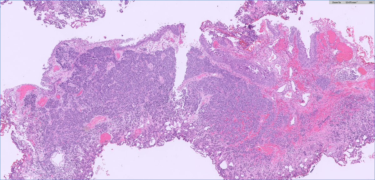 slusagar's tweet image. #GUpath TURBT:

small cell carcinoma ➕concomitant urothelial carcinoma in situ

curiously: both elements share aberrant loss of Rb1