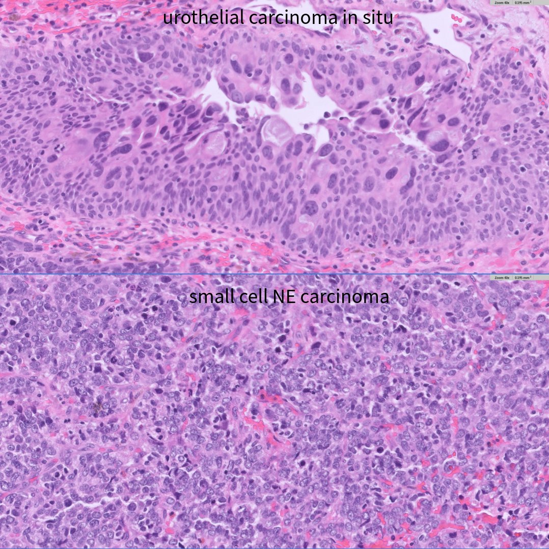 slusagar's tweet image. #GUpath TURBT:

small cell carcinoma ➕concomitant urothelial carcinoma in situ

curiously: both elements share aberrant loss of Rb1
