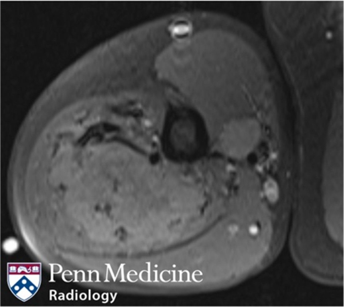 AuntMinnie's tweet image. How would you diagnose this case? 27-year-old man with right upper extremity mass #radiology @PennMedicine buff.ly/6E4imVr