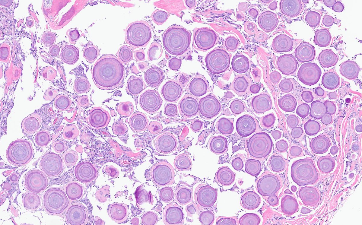 CraigHorbinski's tweet image. One image is all you need to answer the following:
1.) What's the diagnosis?
2.) Where is this located?
3.) What sex is the patient?
#pathology #neuropath #pathtwitter