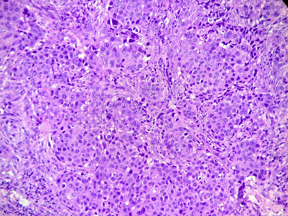 pathognosis22's tweet photo. #Case178 salivary duct carcinoma. Tumor positive for Her2, CK7 and AR. #HeadNeck #Pathology #Pathognosis #Salivary_tumor https://t.co/FS8qwJsp2r