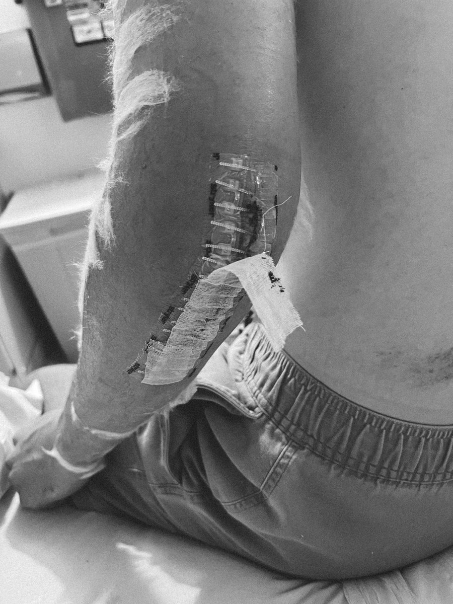 pairedupstories's tweet photo. 20 months ago I was assaulted on the sidewalk in Los Angeles and had a rare, emergency elbow surgery.

Today I played my first round of golf since. What a feeling! https://t.co/GOAh8G8Xh8