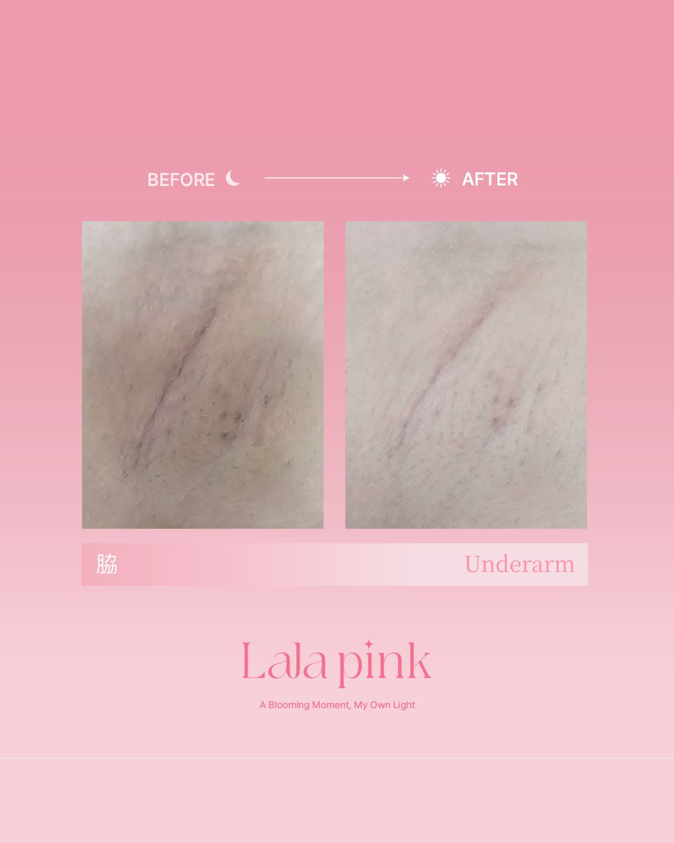 黒ずみ、隠してない？

本来は
隠すものじゃなく
整えるもの。

メラニンに特化したケアで
肌本来の色味へ。

韓国では常識のケア。

ララピンクで
透明感のある肌へ✨

#リンリン
#肌管理サロンリンリン
#ララピンク