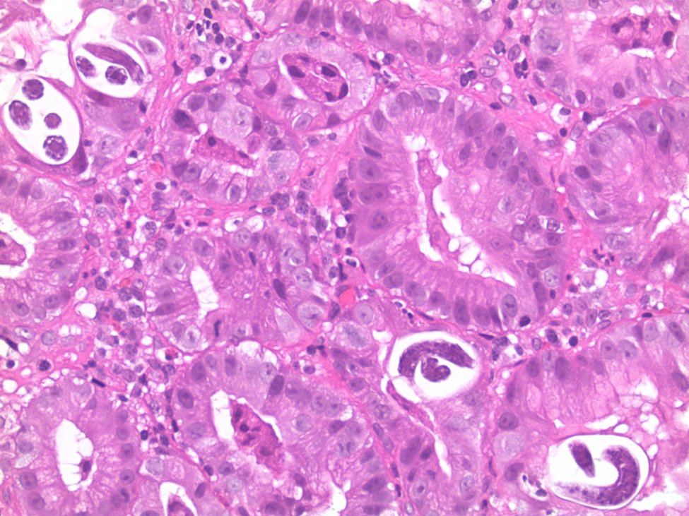 MhPathology's tweet photo. What’s that inside the gastric crypts of an immunocompromised person?

🪱Strongyloides stercoralis!
✨Adult worms, eggs, and rhabditiform larvae reside in gastric pits or interepithelial tunnels.

#Microbiology #gipath #MHPathology #cwru #pathX #PathTwitter https://t.co/JFfjg0py6w