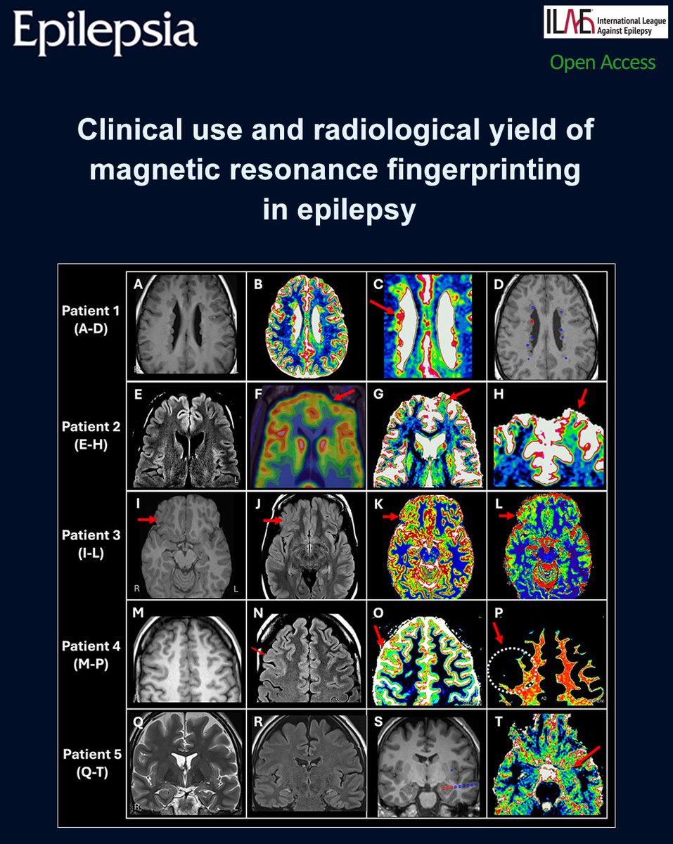 EpilepsiaJourn's tweet photo. Clinical review of MR Fingerprinting, a novel quantitative MRI technique, provided 41 added value in 46% of epilepsy presurgical patients.
https://t.co/oa2njnS831
#epilepsy #ILAE #epilepsia #epilepsysurgery #focalcorticaldysplasia #MRfingerprinting #PVNH #quantitativeMRI https://t.co/rY7AE7Z4fk