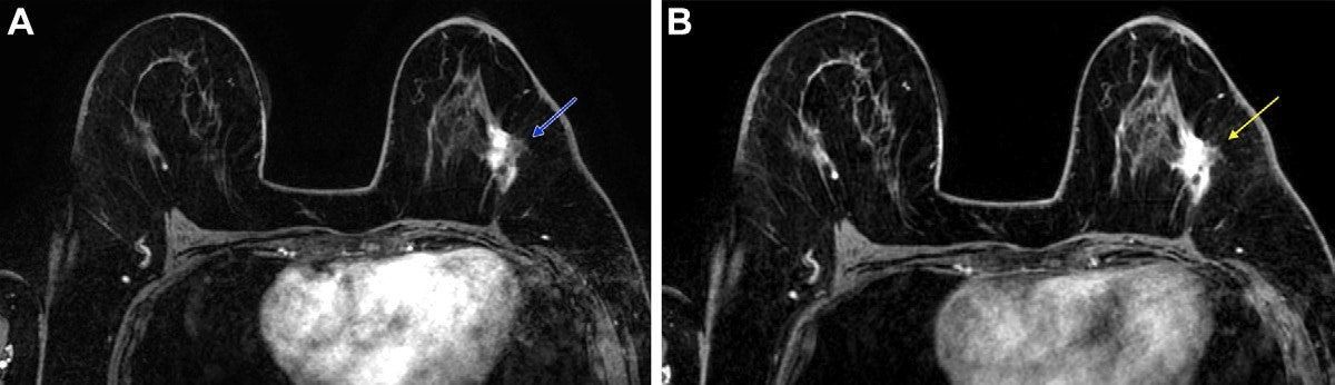AuntMinnie's tweet image. Abbreviated breast MRI after chemotherapy comparable to full protocol #radiology #breastcancer #MRI @MSKCancerCenter buff.ly/RtOG0JM