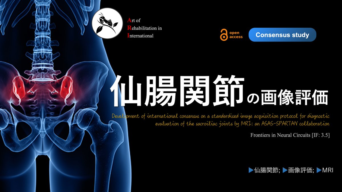 copellist's tweet image. Legacy of Ari💡
“仙腸関節の画像評価”

2024年10月28日5:33
🌱note：note.com/super_human/n/…

・標準化されたMRIプロトコルを開発
🔹評価の基準：S2椎体の背側皮質
🔹4つの主要なシ－ケンス(MRIのT1, T2)
　→様々な側面の評価

仙腸関節のMRI画像評価❗️
興味深いテーマです😲
#仙腸関節 #MRI #評価