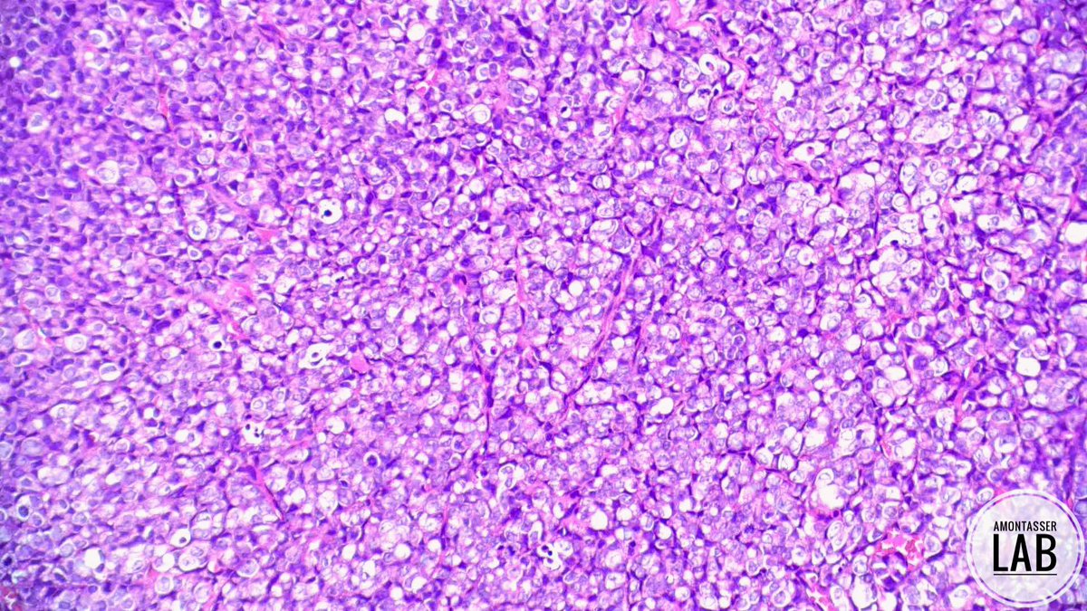 AMontasserMD's tweet image. Prostate: Gleason Pattern 5️⃣ 

#GUpath #PathX #PathTwitter #Pathology