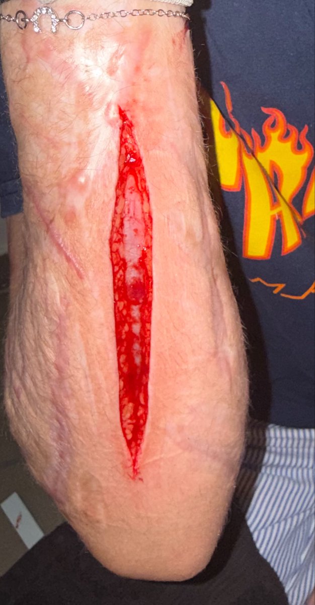 twt_borderline's tweet photo. I was 1 month clean but have a relapse today, i don’t think it’s bad enough or deep enough… I want it to hurt ass hell…
#shtwt all fake https://t.co/TPYo9K7qyW