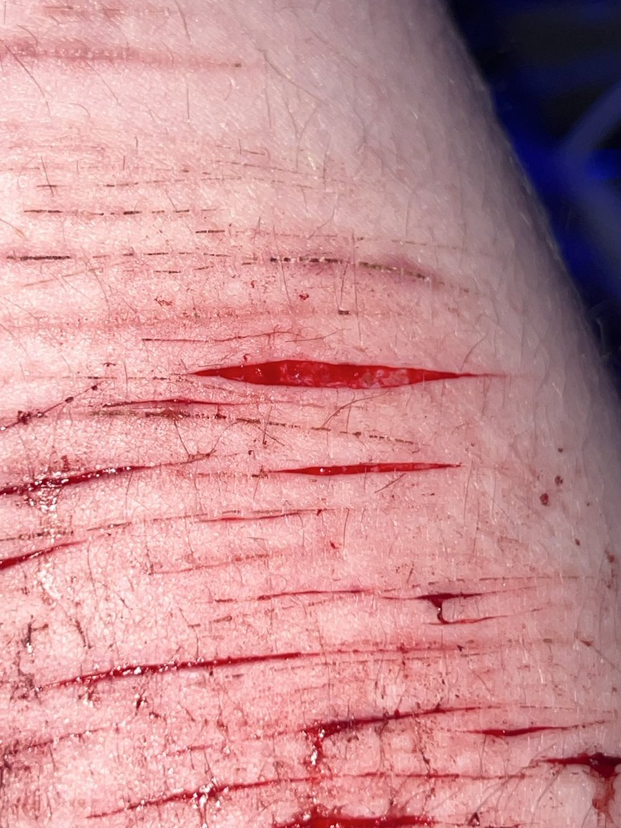 g0recake_rin's tweet photo. im so proud of myself for going this deep🤍
#shtwt #edtwt #shedtwt #cutspo #slashspo #slashed #cutting https://t.co/IDMfUbfDid