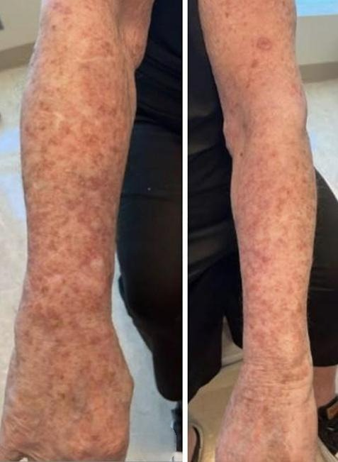 semaglutide side effects itchy skin Diagnosis: Semaglutide-induced photodistributed drug eruption  (photodermatitis). Histopath showed a mixed spongiotic, psoriasiform, &  interface dermatitis w/ eosinophils, consistent with a drug-induced  hypersensitivity reaction. The pathogenesis is