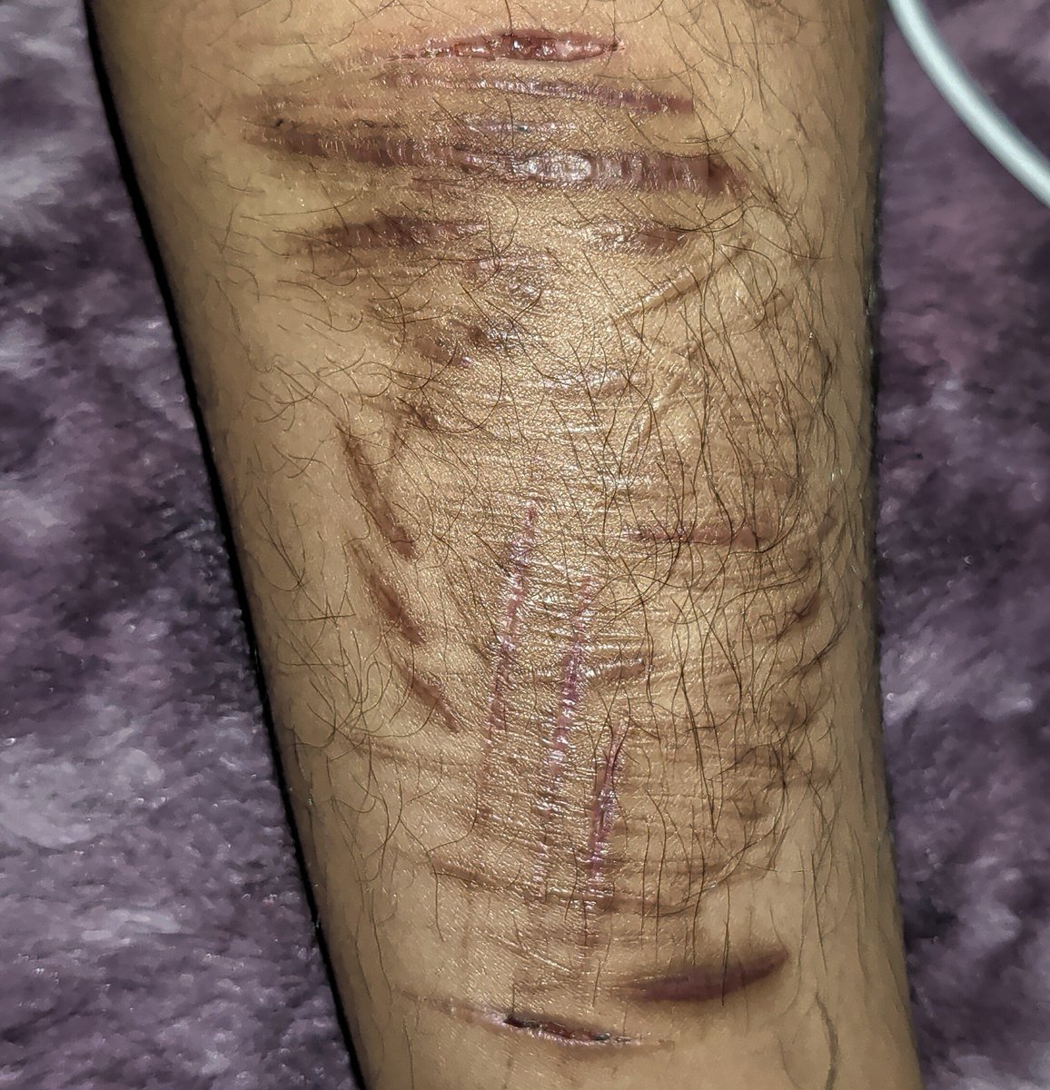 RandalO__o's tweet image. New phone/camera, scar check #shtwt #shedtwt