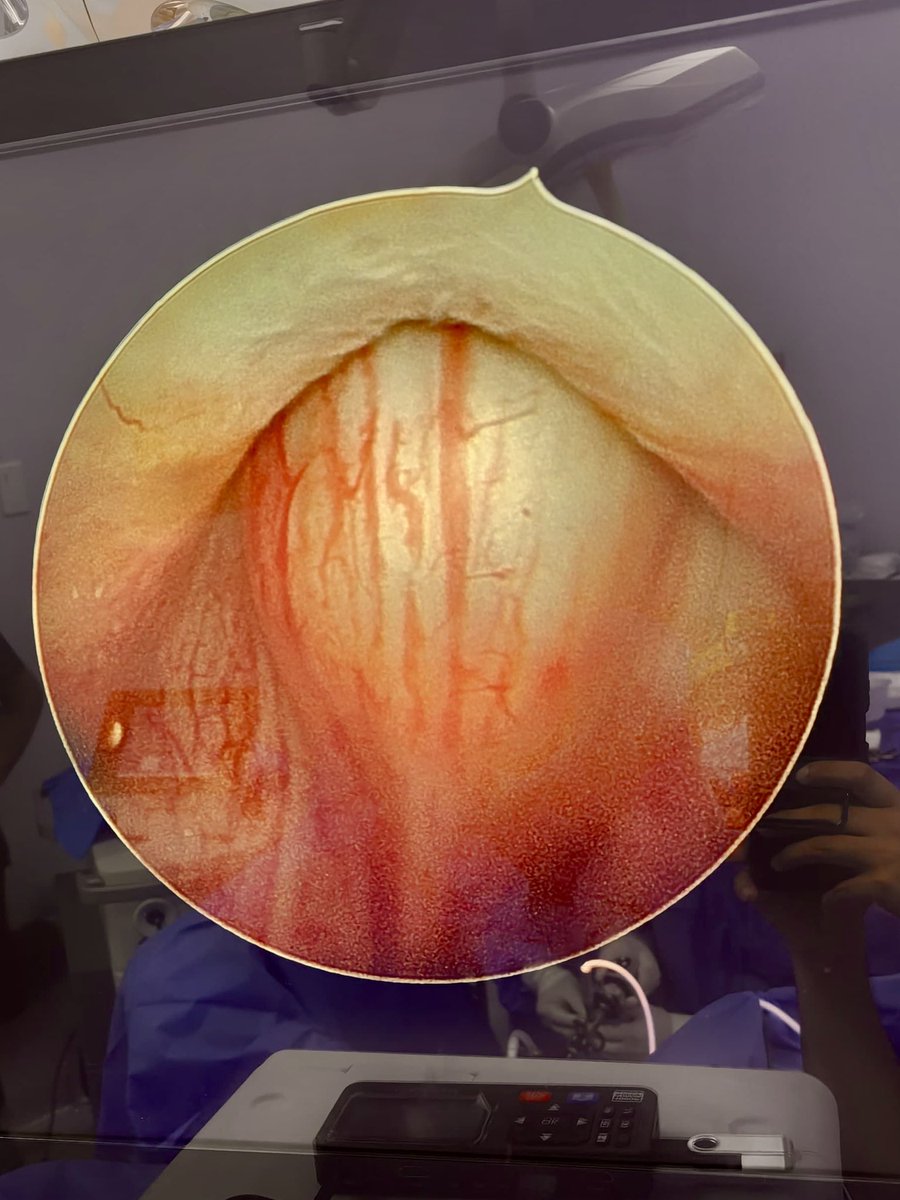 oliper01's tweet image. Qué tal este lóbulo medio en una próstata de 38 CC pero con orina residual de 150 CC. Paciente totalmente obstruido . #urosome #holep #urologia #urologo #urology #prostate