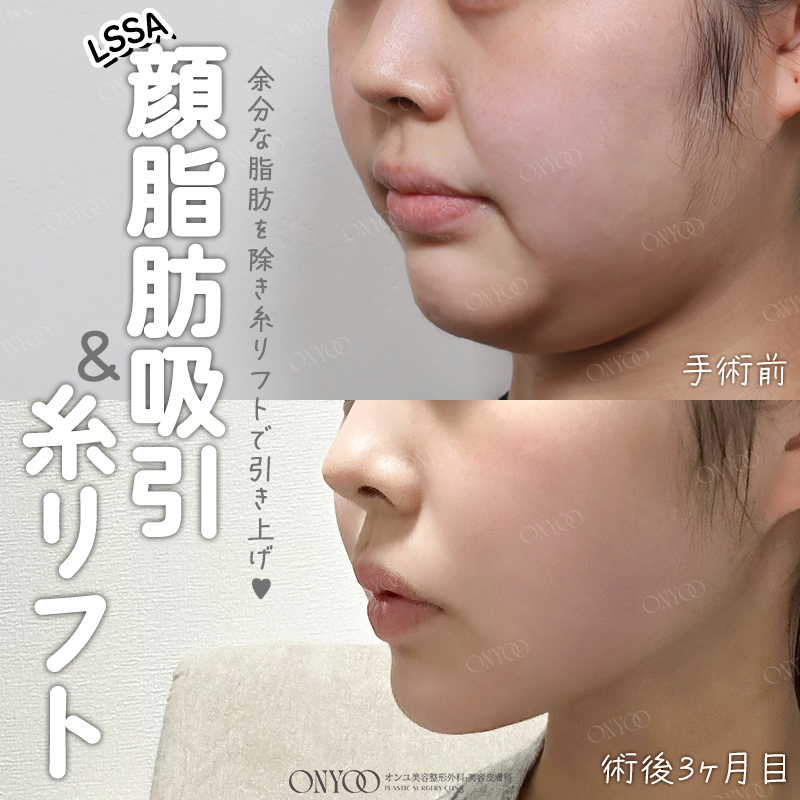 オンユ美容整形外科・美容皮膚科 【額縮小/挙上/リフトアップ】専門🎖 tweet media