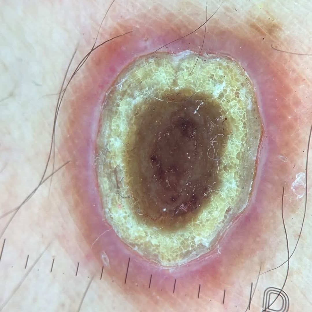 Spot diagnosis❔

Dermoscopy: Central yellow-brown structureless area corresponding to a keratotic crust, surrounded by a white collarette, with an outer erythematous (pink) halo.