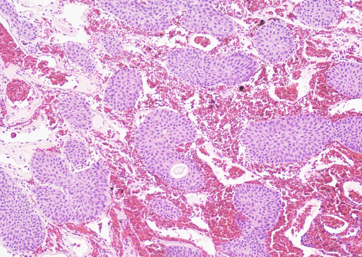 GuannanTiffany's tweet image. 🧩 Bloody Bladder
When signing out this lesion, what clinical question comes to mind?

👨 65-year-old man
• Prior prostate adenocarcinoma?
👩 45-year-old woman
• Prior cervical carcinoma?
not always.

So… what’s the diagnosis? 🤔
#DxMindMap #BladderTumor #PathTwitter #JHUPath