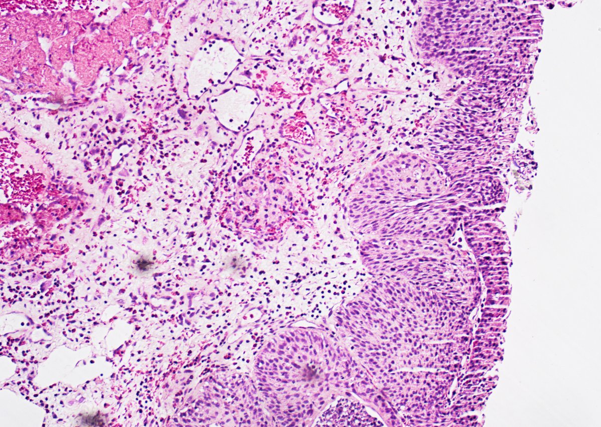 GuannanTiffany's tweet image. 🧩 Bloody Bladder
When signing out this lesion, what clinical question comes to mind?

👨 65-year-old man
• Prior prostate adenocarcinoma?
👩 45-year-old woman
• Prior cervical carcinoma?
not always.

So… what’s the diagnosis? 🤔
#DxMindMap #BladderTumor #PathTwitter #JHUPath