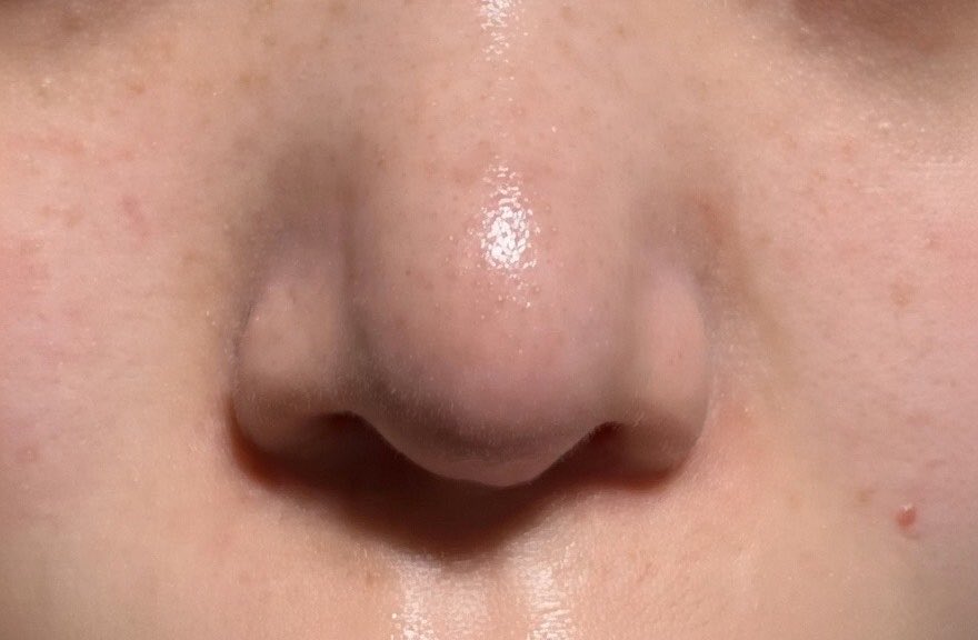 鼻整形の病院探し🏥鼻尖形成、貴族手術、人中短縮、鼻中隔延長、鼻フル、プロテーゼ、鼻翼縮小、小鼻縮小 tweet media