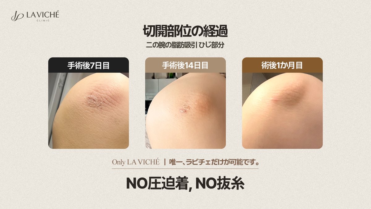 ラビチェ医院【脂肪吸引・脂肪吸入・脂肪移植・豊胸・脂肪豊胸・二重顎・二の腕・腹部・太もも・全身】 tweet media