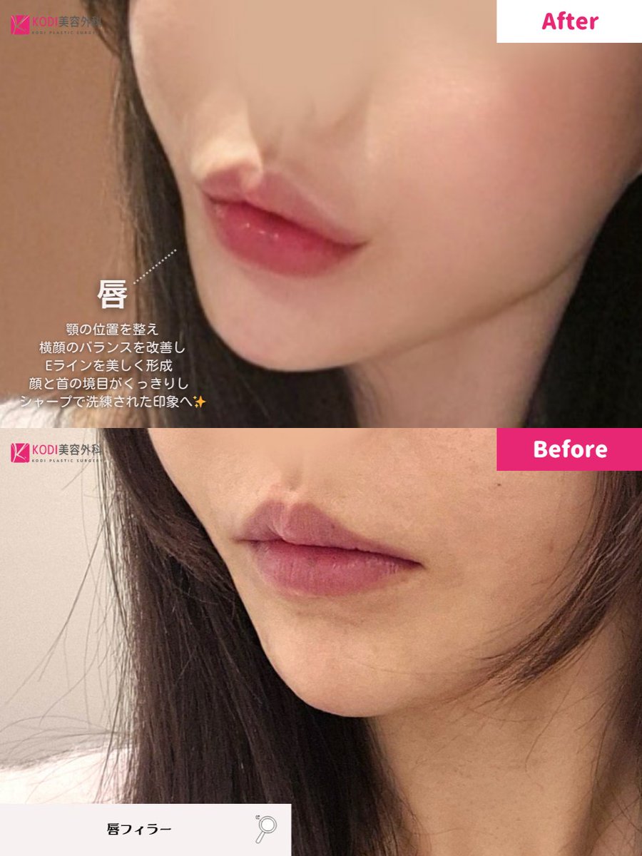 KODI美容外科💖江南でフィラーするならコディ💖 tweet media