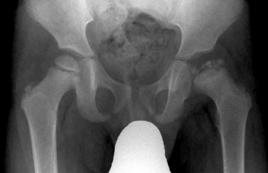 terapiamanualUE's tweet photo. 🧒 ENFERMEDAD DE LEGG-CALVÉ-PERTHES: claves diagnósticas para el fisioterapeuta.
La ELCP es una osteocondrosis idiopática por necrosis avascular de la epífisis femoral proximal de la cadera en niños de 4 - 8 años, con mayor prevalencia en varones. https://t.co/lE3qVOiH1h