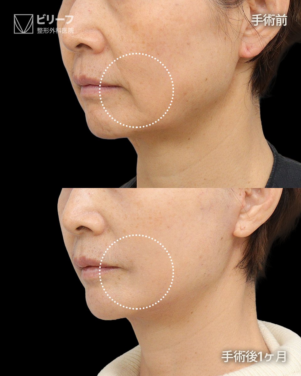 ✨韓国フェイスリフト専門ビリーフ美容外科✨ tweet media