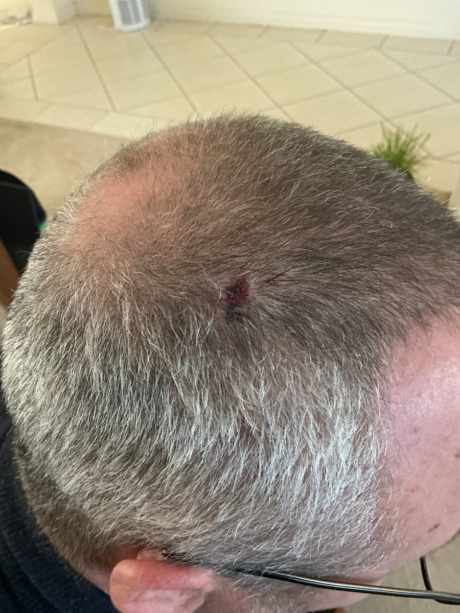 4 moles cut out today for investigation. Got kid to take a photo of scalp one. I knew my hair was thinning, but didn’t realise it was almost bald now!!!!😢😢😢