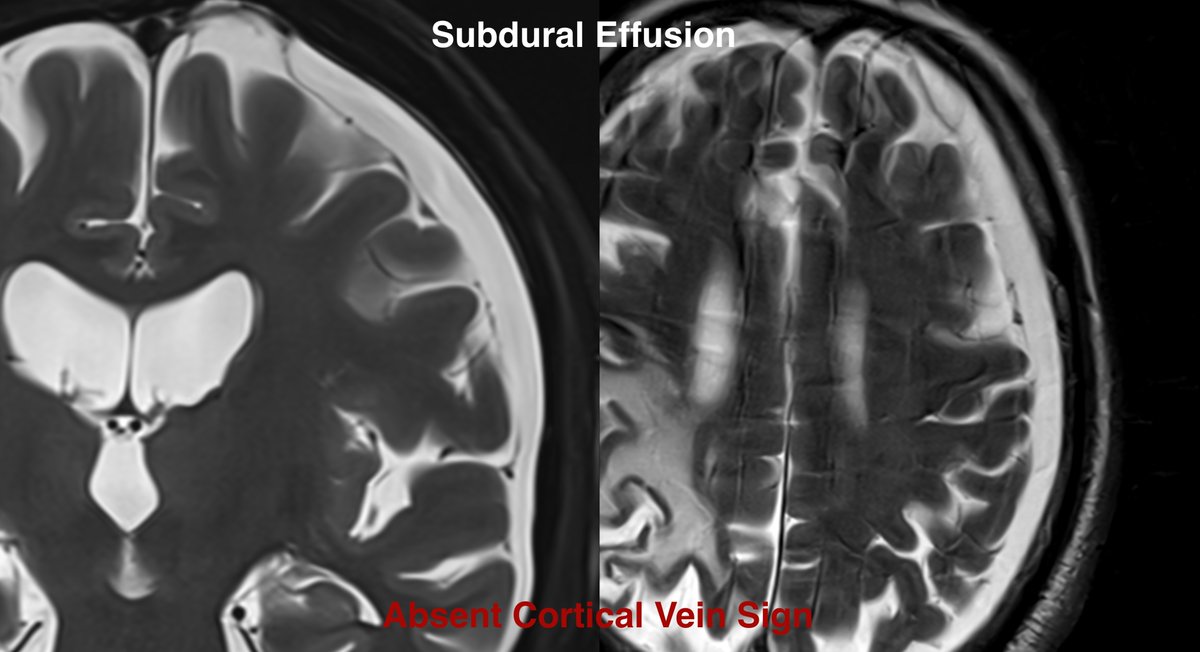 mehtanikhil's tweet photo. SDE vs BESS radiological differentiation pearl. #NeuroRad #radiology #Macrocephaly #neurology #radres https://t.co/H5HqqPxBqu