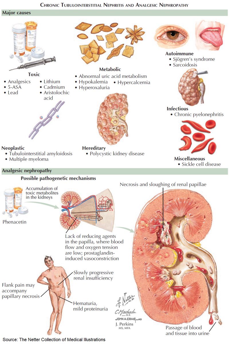 ManualOMedicine's tweet image. Chronic Tubulointerstitial Nephritis and Analgesic Nephropathy

#medtwitter #foamed #meded