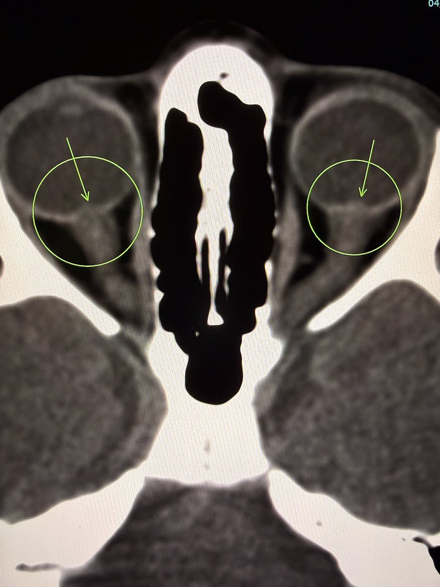 samrad77's tweet image. Papilledema on CT.

Look for subtle posterior globe flattening.

In the right context, think raised intracranial pressure.

And don’t stop there.
Ask why.

One important cause you don’t want to miss is cerebral venous sinus thrombosis (CVST). Especially when the brain parenchyma