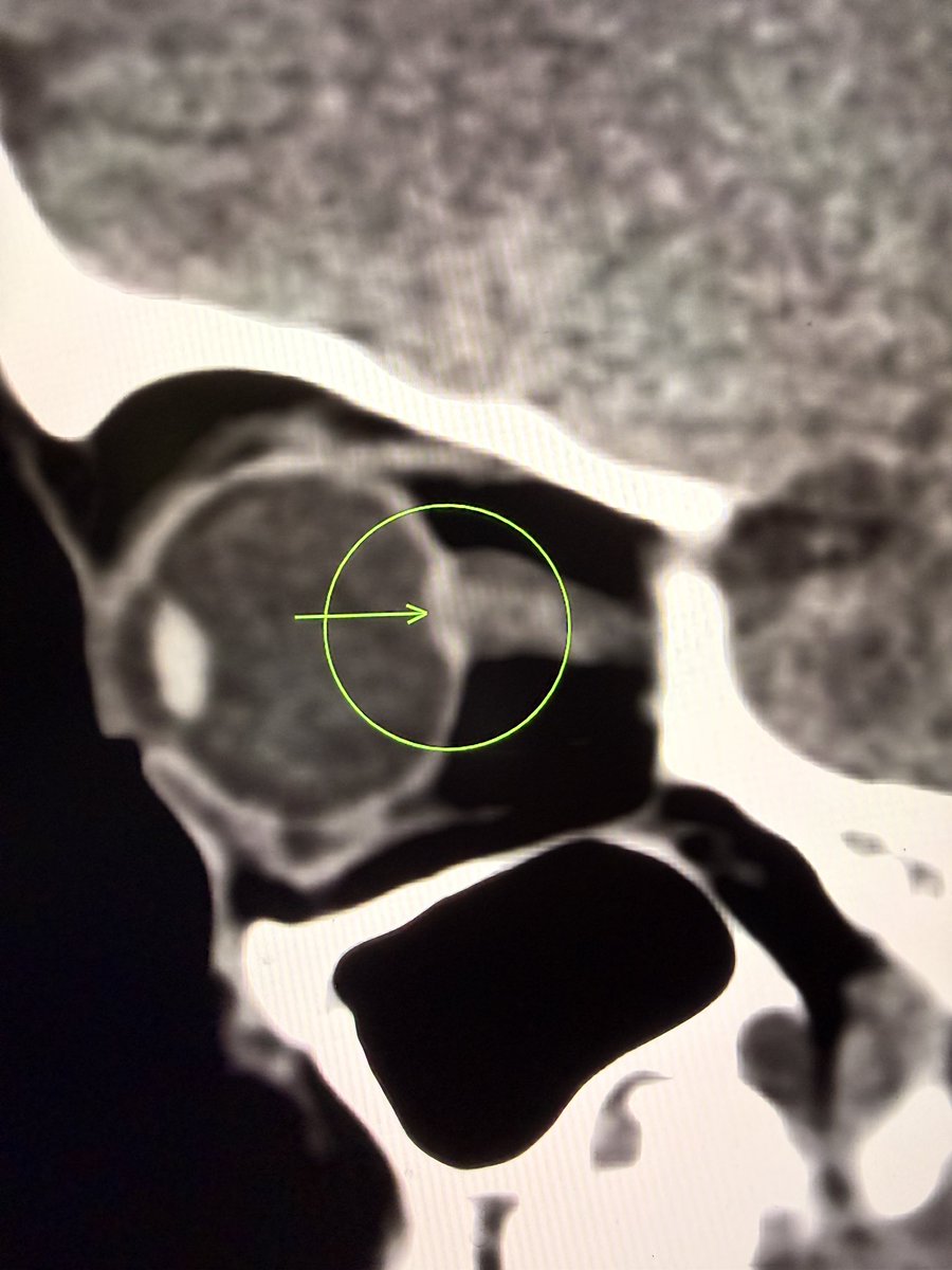 samrad77's tweet image. Papilledema on CT.

Look for subtle posterior globe flattening.

In the right context, think raised intracranial pressure.

And don’t stop there.
Ask why.

One important cause you don’t want to miss is cerebral venous sinus thrombosis (CVST). Especially when the brain parenchyma
