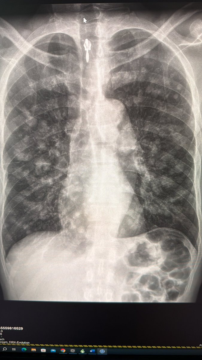 l_hsv8's tweet image. CXR : Cannon ball appearance
CT CAP : Bilateral hilar lymphadenopathy , heterogenoues enlarged prostate and multiple sclerotic osseous lesions .

Primary prostate Cancer with distant metastasis.