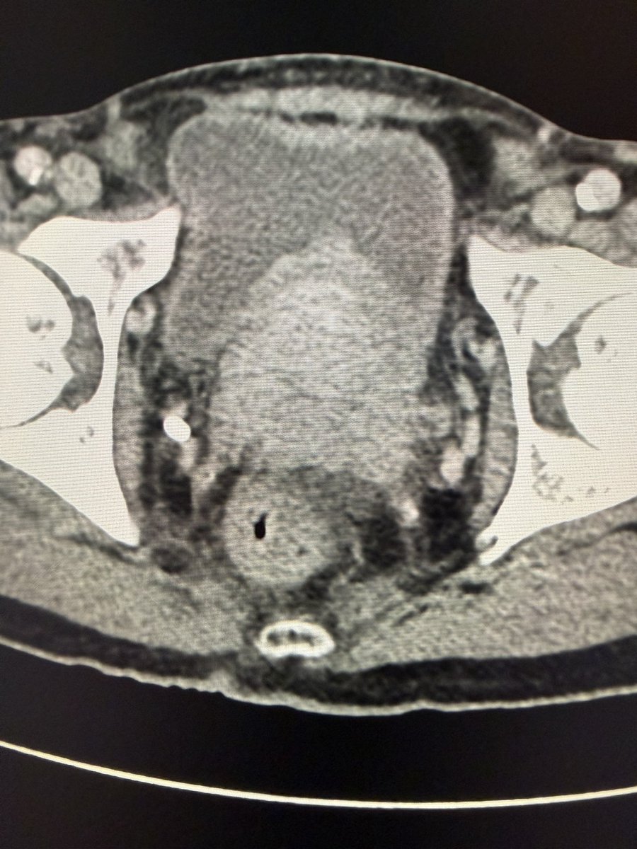 l_hsv8's tweet image. CXR : Cannon ball appearance
CT CAP : Bilateral hilar lymphadenopathy , heterogenoues enlarged prostate and multiple sclerotic osseous lesions .

Primary prostate Cancer with distant metastasis.